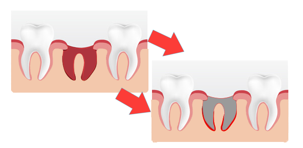 Socket teeth dry Dry Socket